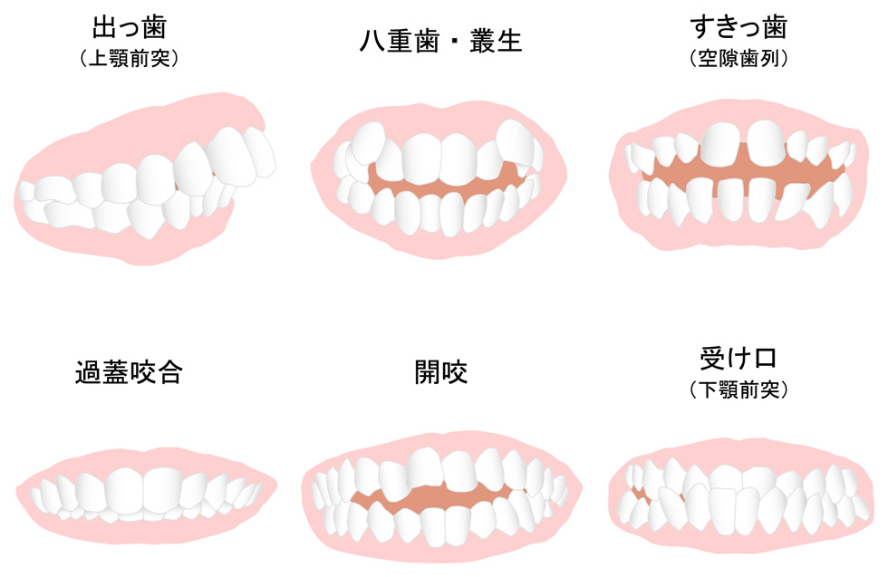 あなたの『歯並び悪い』別タイプはどれですか？