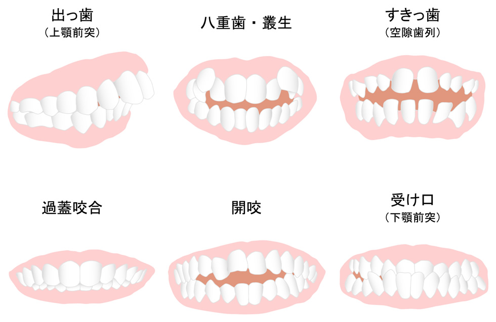 あなたの『歯並び悪い』別タイプはどれですか?