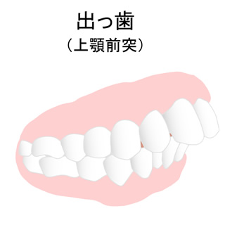 出っ歯 (口ゴボ、ゴボ口)