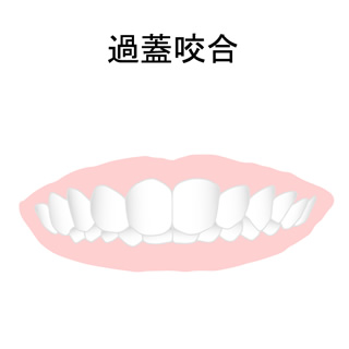 過蓋咬合(噛み合わせが深い)