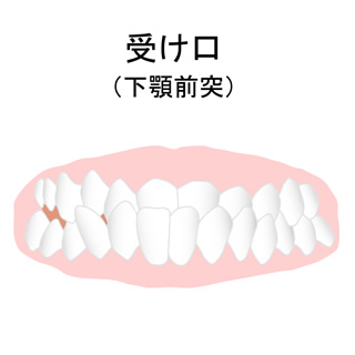 受け口