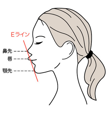 出っ歯