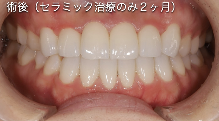 無理な歯列矯正をしてしまった人After