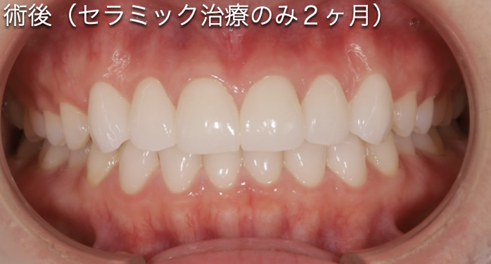 歯が小さい人After