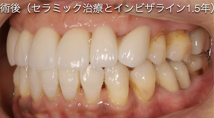 重度の歯周病や骨が少ない人After