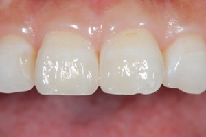 Gap teeth direct bonding example 1 after