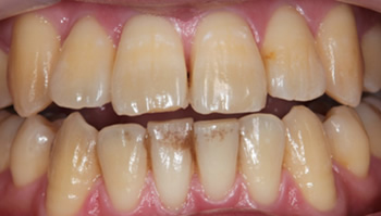 歯の黄ばみ1