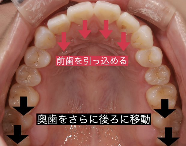 歯を抜かない歯列矯正