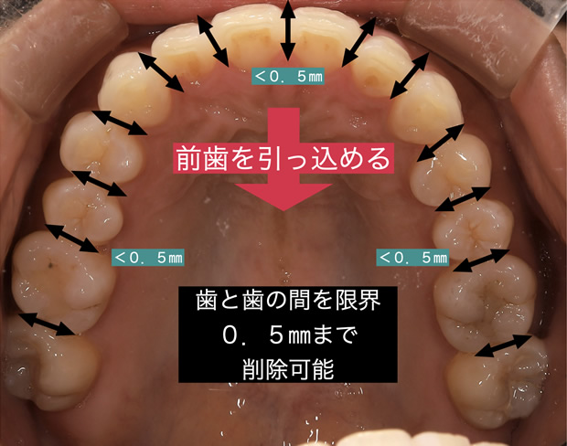 歯を抜かない歯列矯正