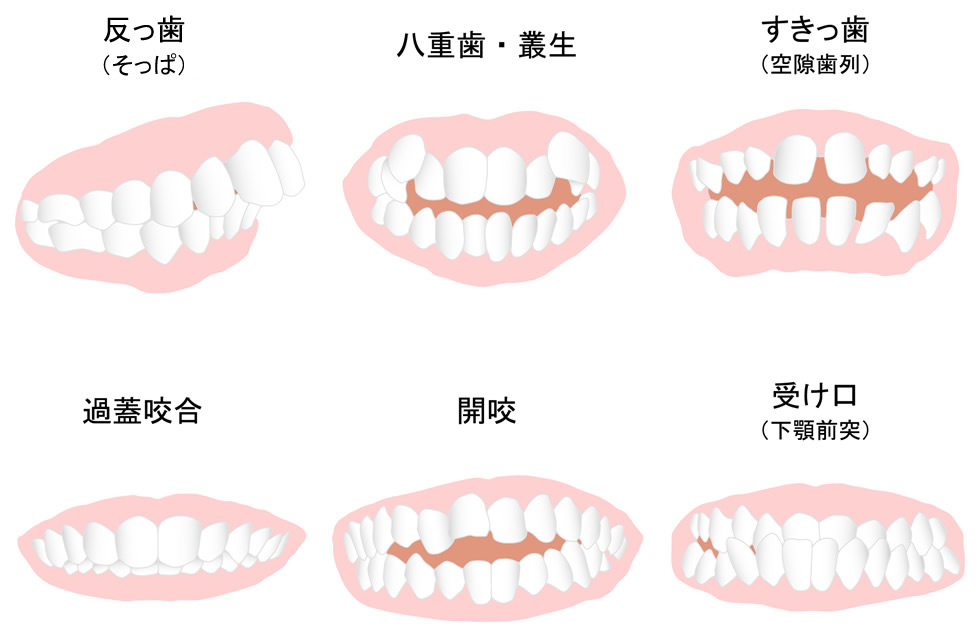 あなたの歯並びはどのタイプ？